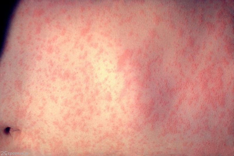 fot. CDC/Dr. Heinz F. Eichenwald / Wikipedia
